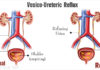 What is vesicoureteral reflux (VUR)? vesico-ureteric-reflux-infection