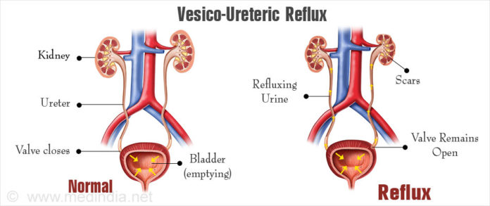 vesico-ureteric-reflux-infection