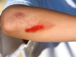 Cuts & Scrapes: First Aid